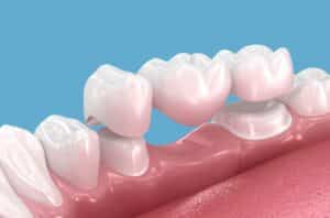 dental bridges near me