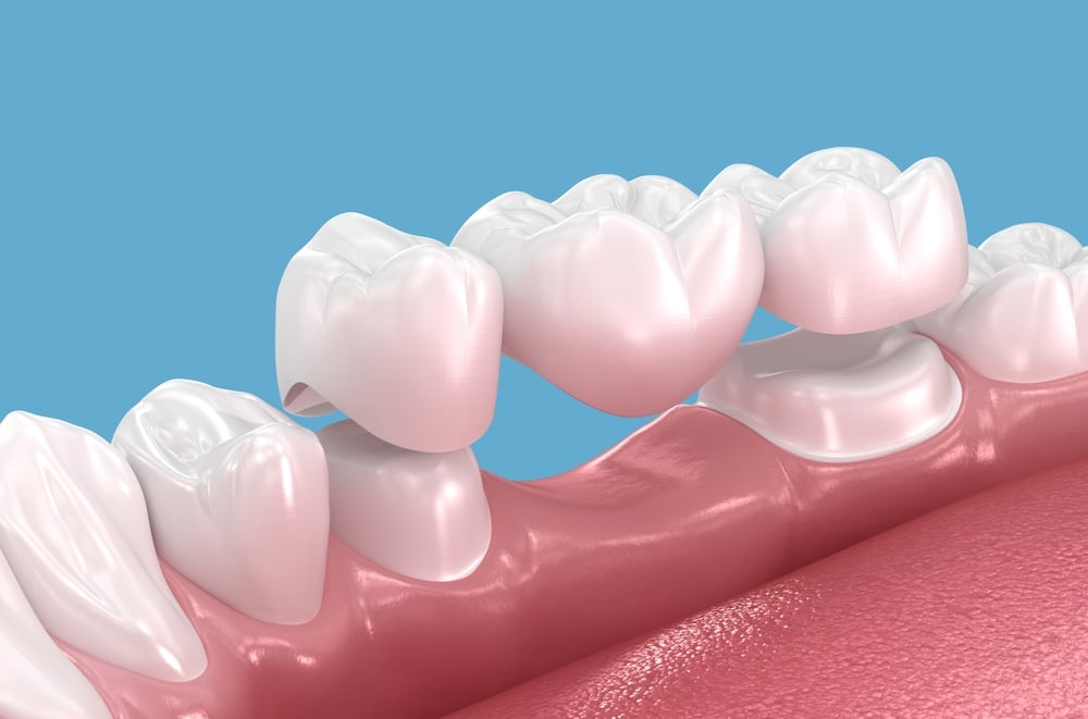 dental bridges near me
